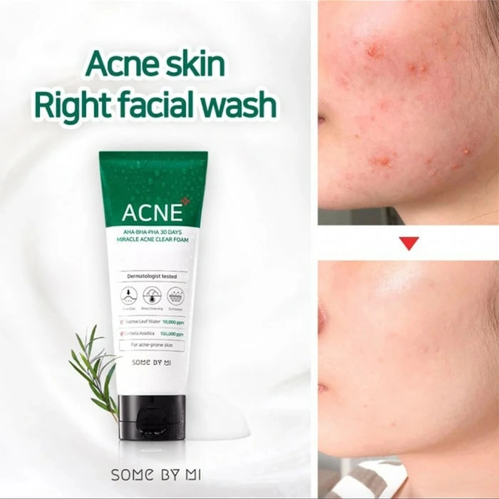 Some By MI AHA BHA PHA 30 days miracle ACNE foam  YUZ YUVISH PENKASI bo'lib to'lash